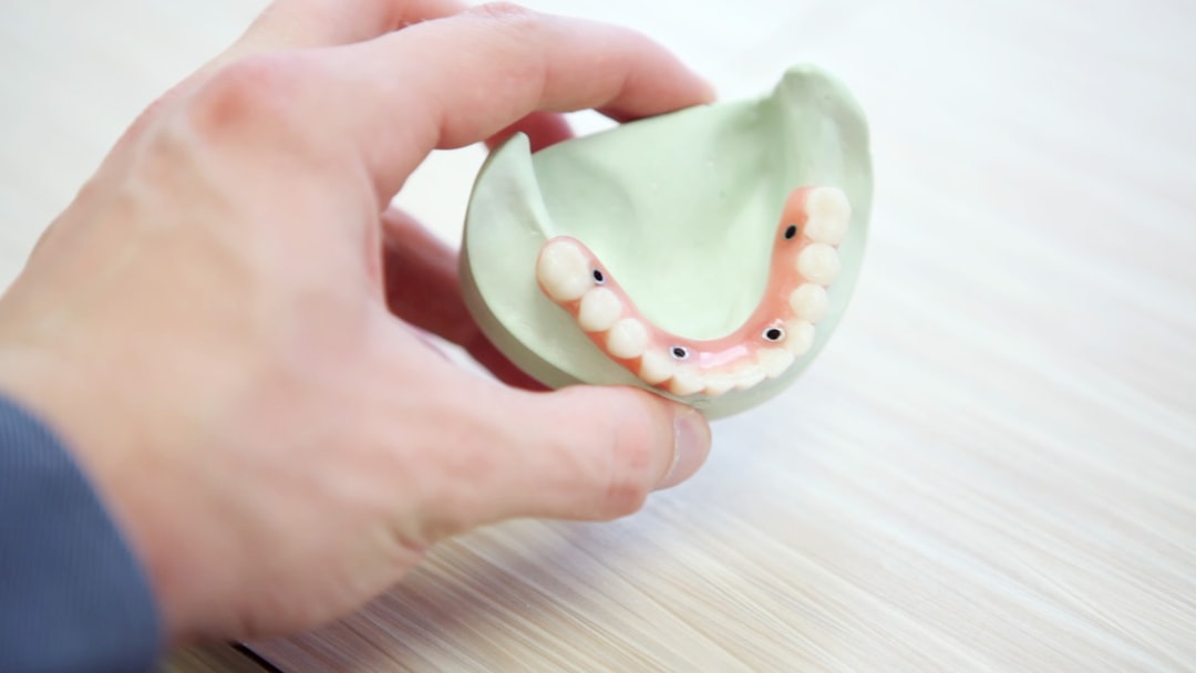 Full-arch implant prosthesis on a model