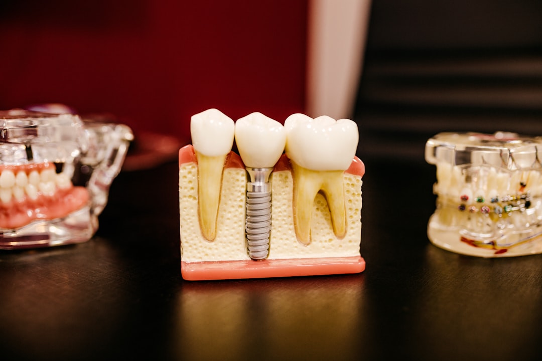 Model showing an implant crown between natural teeth