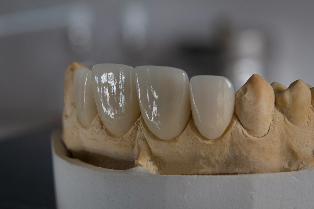 Finished crowns seated on a stone model